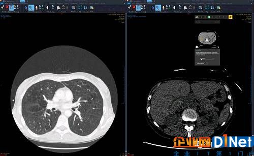 同样是在医学影像方面，2017年11月，深度学习影像分析公司Zebra Medical Vision宣布，该公司所有已发布和未发布的放射算法将在Google Cloud上启用。